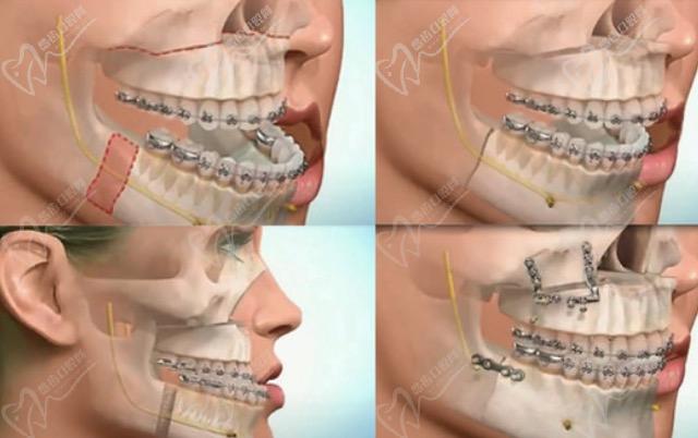 正颌手术过程
