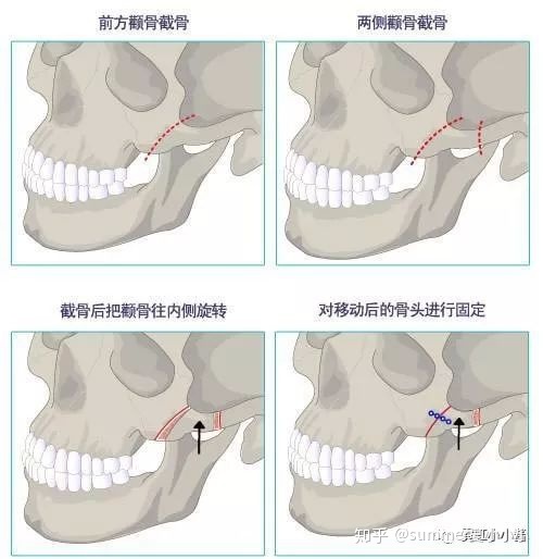 男人额头窄颧骨宽面相_男人颧骨高额头窄面相_颧骨高下颌角宽额头窄面相