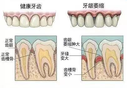 牙缝太大，吃东西老塞牙怎么办？我的牙缝好大？