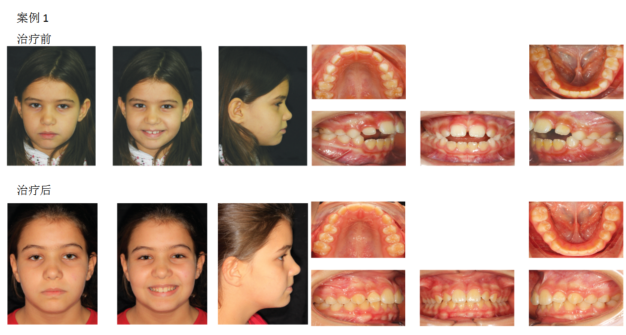儿牙矫治的第一个黄金期——儿童早期矫治
