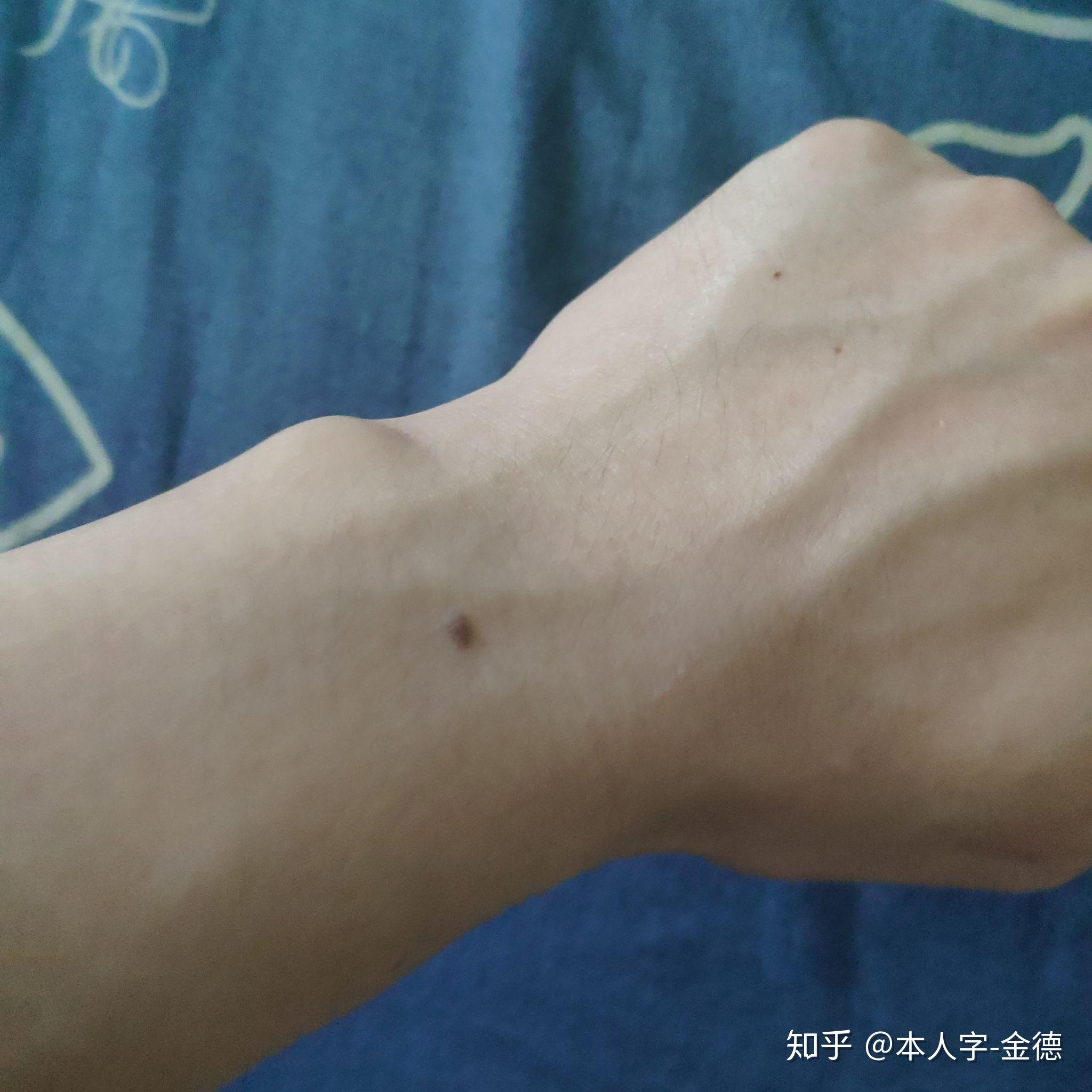 （李向东）手腕上长痣蕴含着什么命运信息？