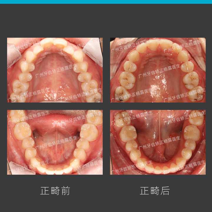 嘴凸背后的“秘密”，你真的了解吗？