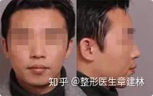 什么是双颌前突？.突的矫正方法