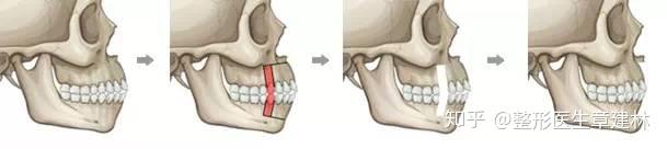 什么是双颌前突？.突的矫正方法